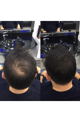 ألياف توبيك لمشكلة الصلع 