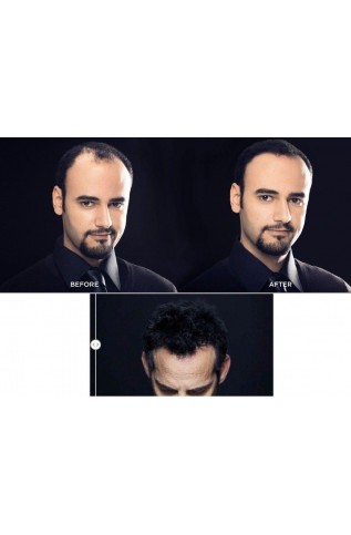 ألياف توبيك لمشكلة الصلع